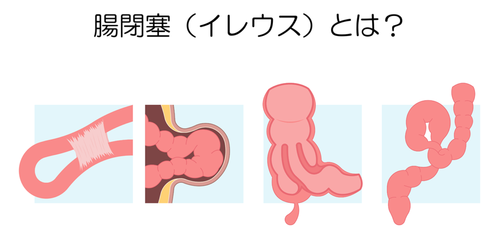 腸閉塞の症状