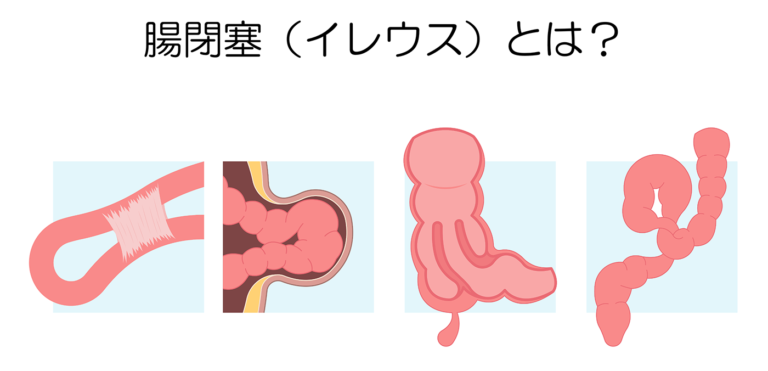 腸閉塞の原因は何ですか?