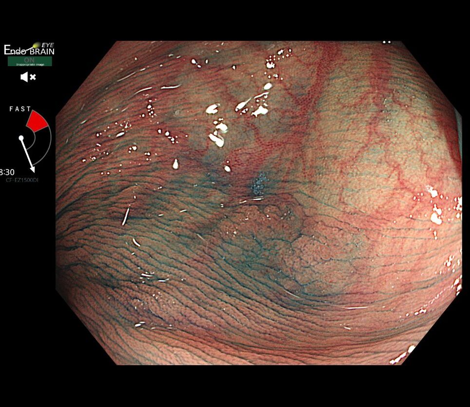 通常光でのSSA/P（粘液付着）