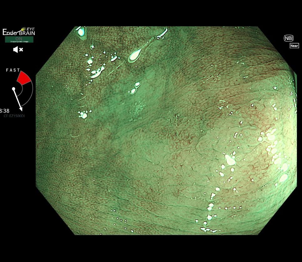 拡大NBIでのSSA/P（開Ⅱ型ピットパターン）