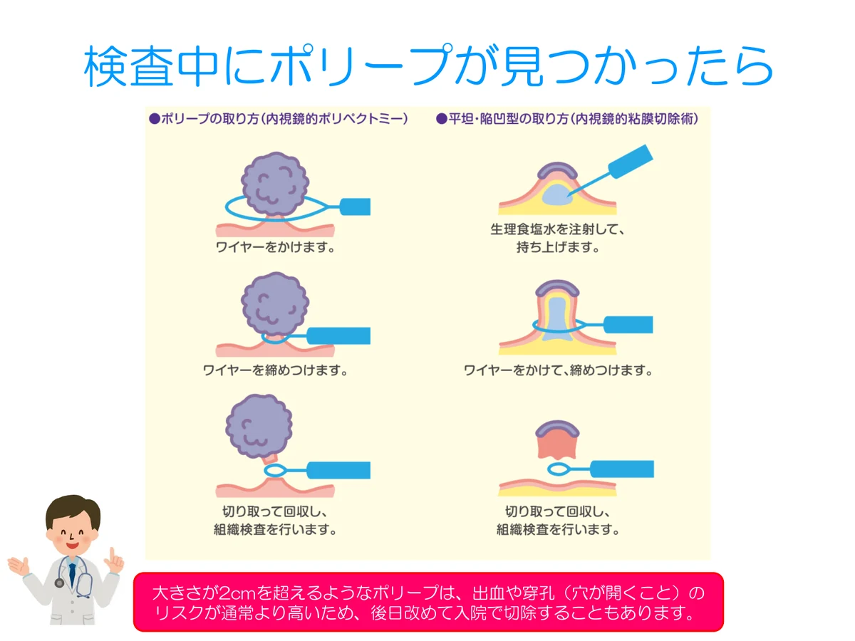 検査中にポリープが見つかったときの切除説明図